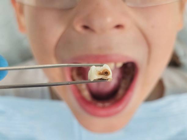 Best Emergency Tooth Extraction in Branford Center, CT